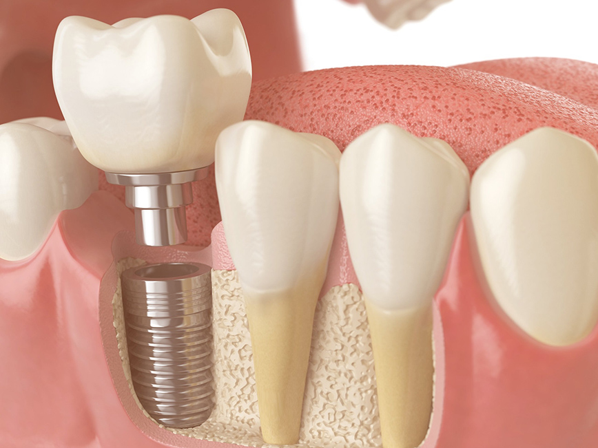 quanto custa um implante dentário