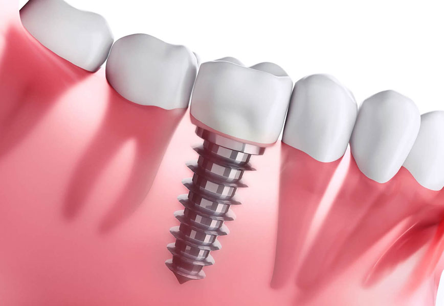 Tudo que você sempre quis saber sobre implante dentário